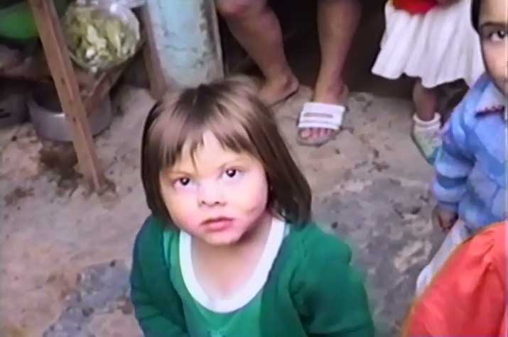 Had acid poured on her face as a baby. Looking a lot better.